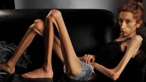 anorexia-deadly-mental-illness